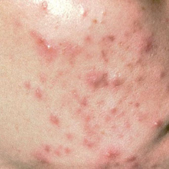 Mụn ẩn, mụn viêm sưng