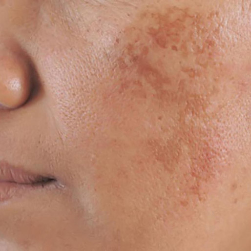 khô da, nám da, sạm da